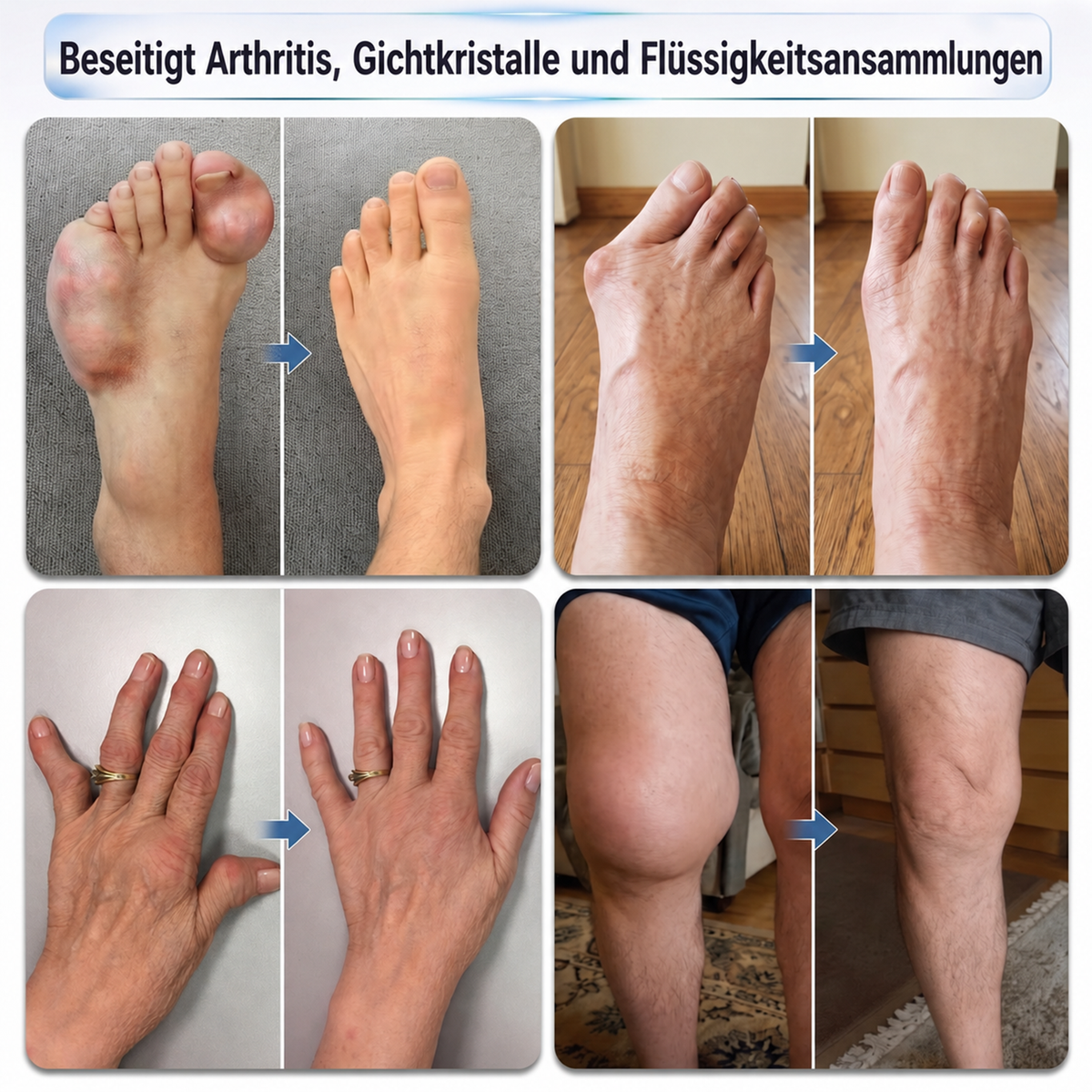 𝐈𝐅𝐌𝗔𝗚𝐈𝐂® 👩‍⚕️ 𝟎,𝟎𝟓 𝐦𝐦 𝐌𝐢𝐤𝐫𝐨𝐧𝐚𝐝𝐞𝐥-𝐑𝐨𝐥𝐥𝐞𝐫 𝐟ü𝐫 𝐊𝐧𝐨𝐜𝐡𝐞𝐧 & 𝐆𝐞𝐥𝐞𝐧𝐤𝐞🍃